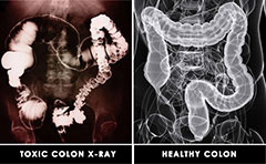 Colon Health Comparison X-Rays